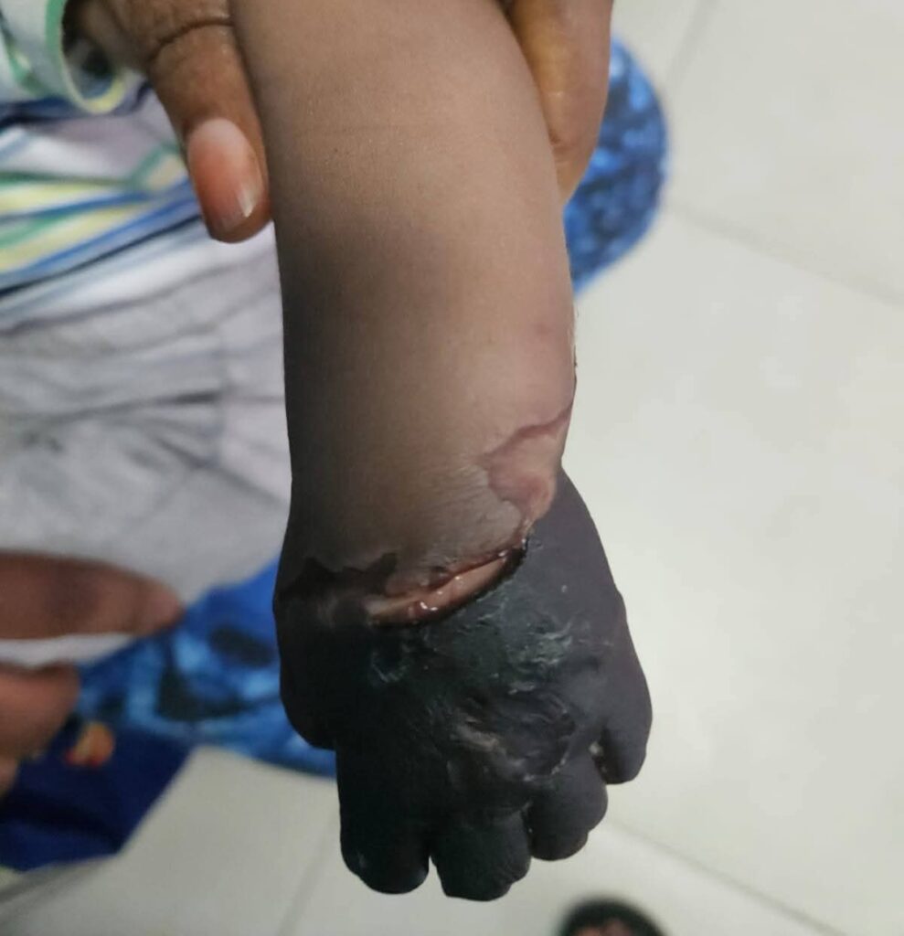Baby Hand To Be Amputated After Hospital Incident